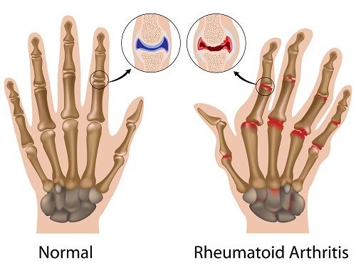 artritis-reumatoide