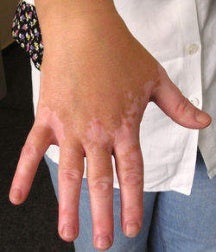 vitiligo2