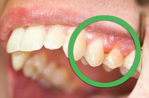 Gingivitis et mal au dent 