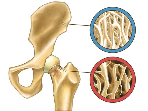 Osteoporosis, ¿cómo prevenir la fractura?