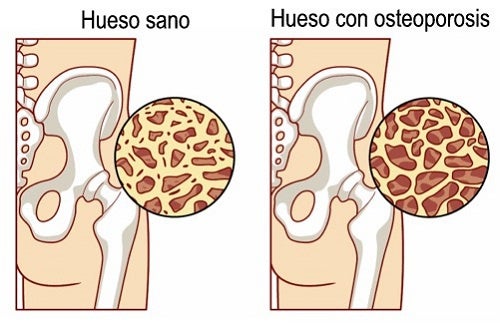 8 Alimentos que previenen la osteoporosis