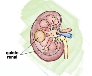 quiste-renal