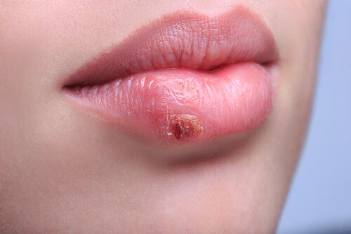 Resultado de imagen de herpes oral