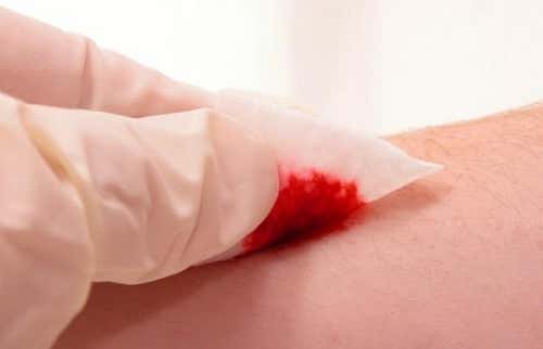 Dermatologist Visit wound