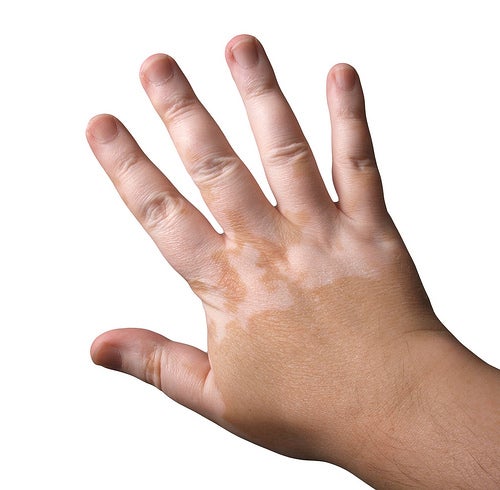 Resultado de imagen para vitiligo