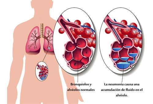 Neumonía o pulmonía