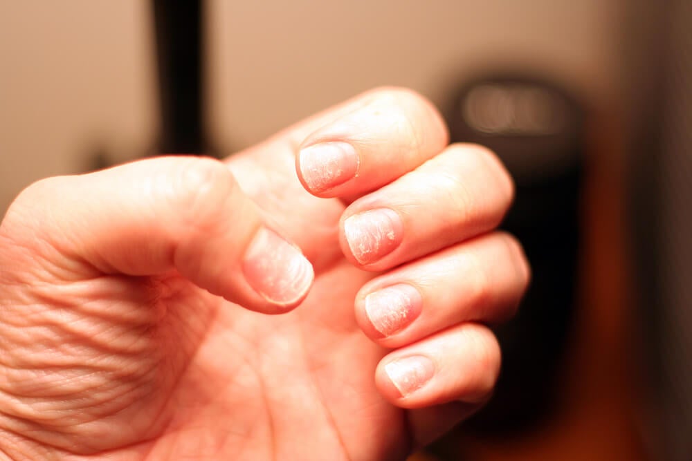 ¿Por qué se descaman las uñas? Causas, tratamientos y soluciones