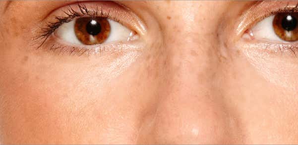 Manchas no rosto causadas por melasma