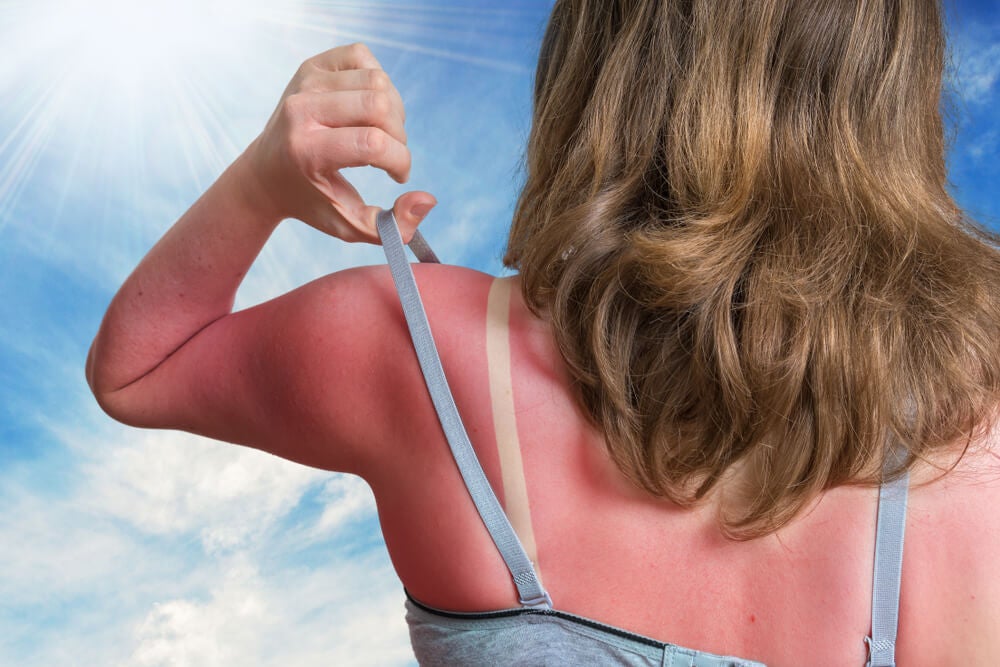 ¿Cómo tratar la piel quemada por el sol? — Mejor con Salud