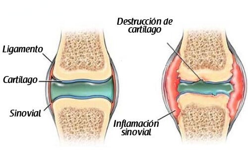 Clavo PRECICE - (alargamiento de huesos para ganar estatura) - España / América Latina - Página 31 Cartilago