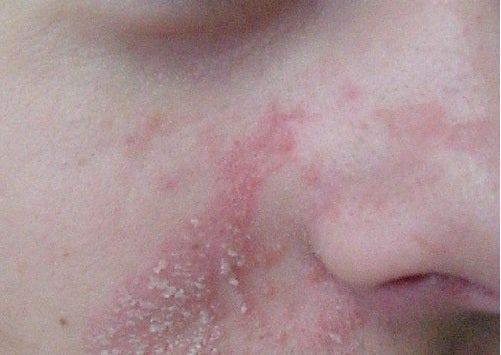 Seborrheic Dermatitis | National Eczema Association