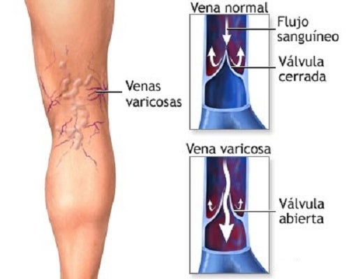traulele ajută la varicoză îngrijirea picioarelor de la varicoză