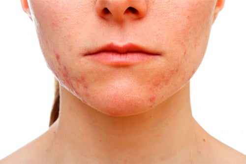 Resultado de imagen para productos grasos para la cara que causen acne