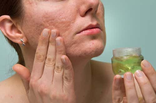 O gel de aloe vera limpa e combate a acne