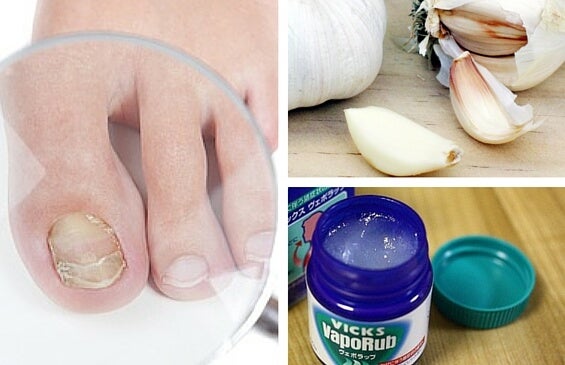 remedios caseros para combatir los hongos en las uñas de los pies y ...