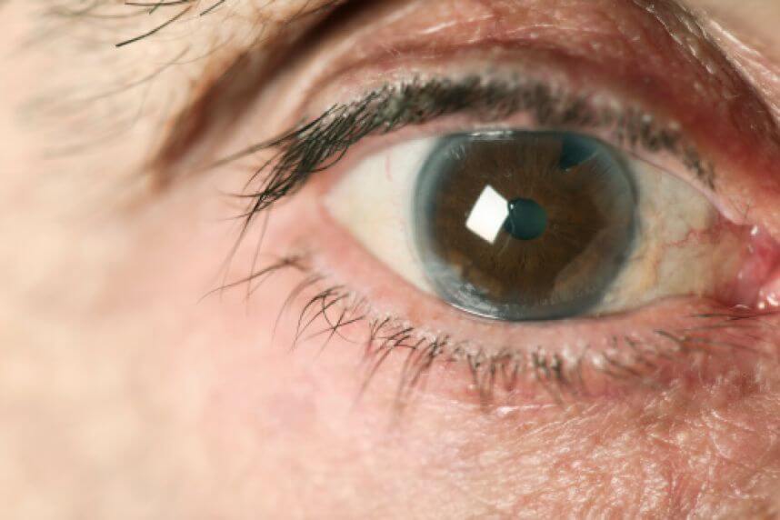 Cómo aliviar el glaucoma con estos 4 remedios naturales