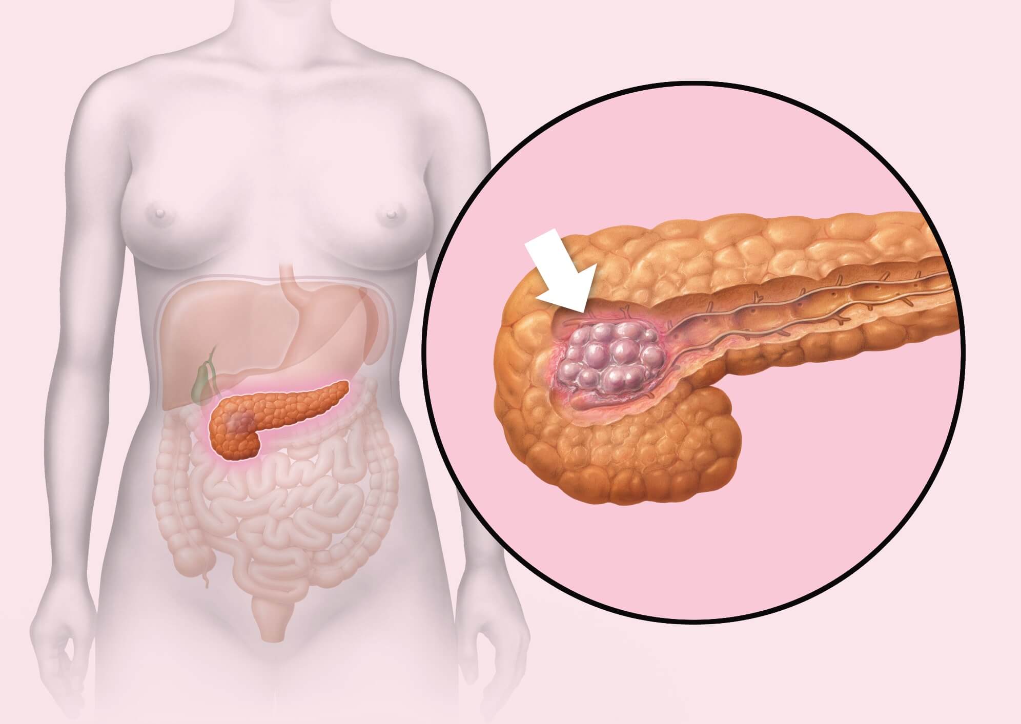 Tipos de tratamiento para el cáncer de páncreas avanzado