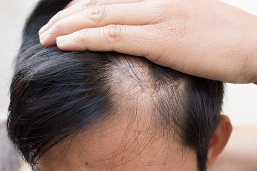 Alopecia: cómo podemos tratarla de manera natural