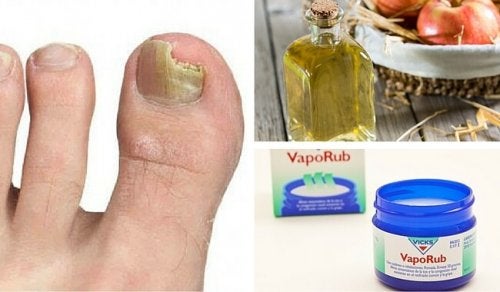 Como curar los hongos de las uñas delos pies naturalmente
