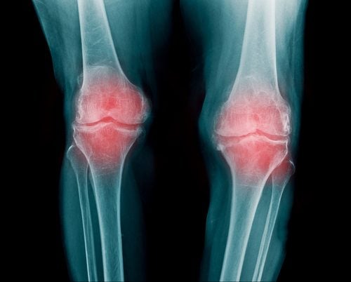Más sobre la osteoartritis