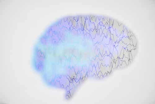 Électroencéphalogramme d'une personne épileptique.