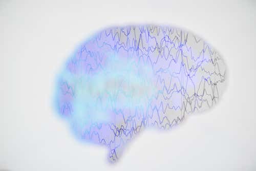 Électroencéphalogramme d'une personne épileptique.
