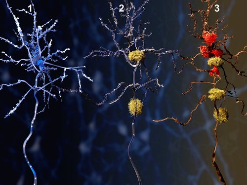 Evolución del Alzheimer en una neurona
