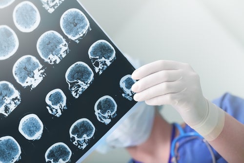 IRM du cerveau pour le diagnostic de l'épilepsie