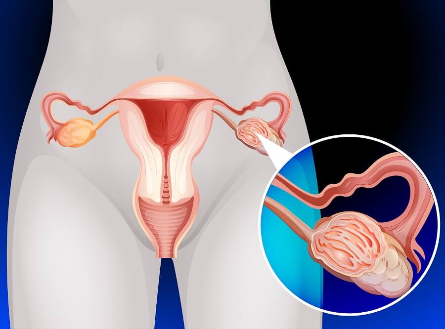 Quistes en los ovarios: síntomas, causas y diagnóstico