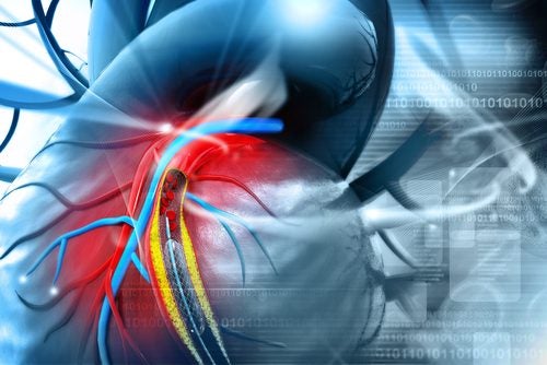 Las placas de ateromas aumentan los riesgos de ataques al corazón.