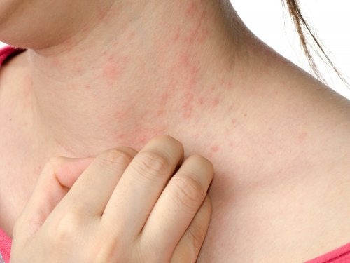 dermatitis, problemas de piel por estrés