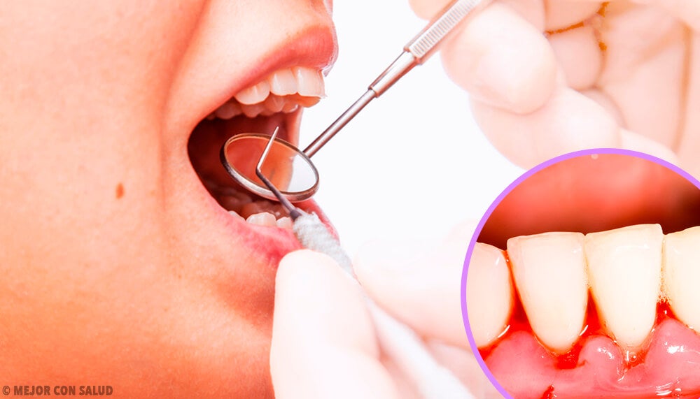 Gingivitis o inflamación de las encías