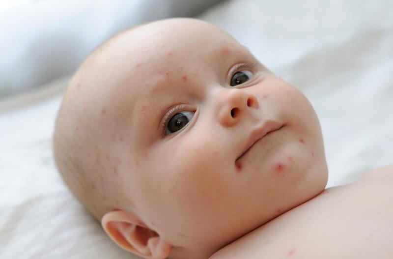 Todo lo que debes saber sobre la varicela en bebés