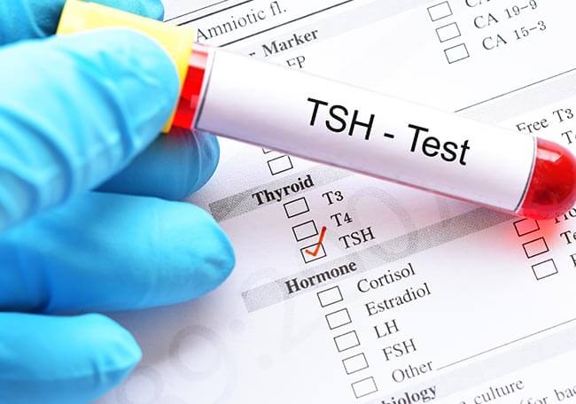 Examen bioquímico de TSH
