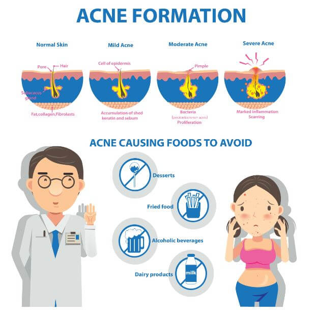 cómo se forma el acné