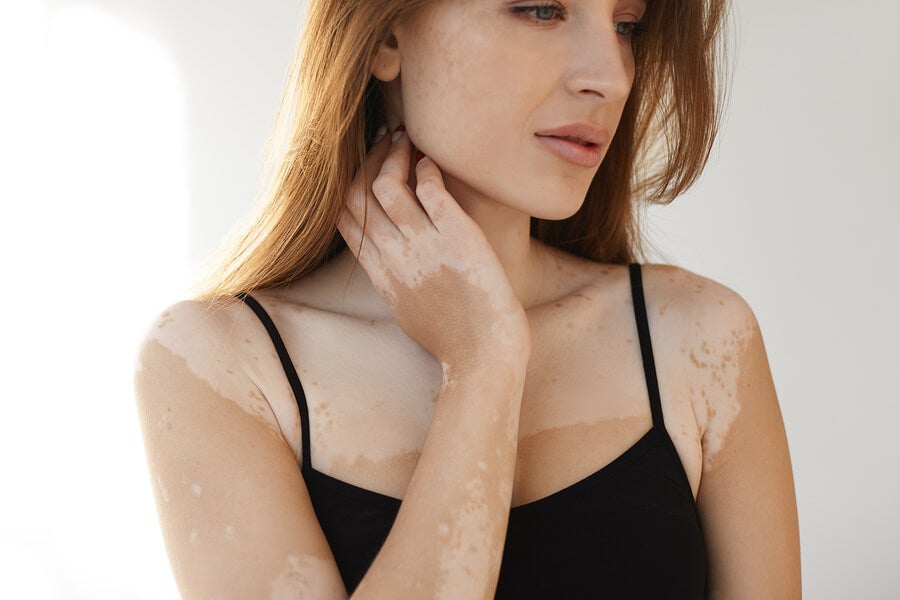 https://mejorconsalud.com/wp-content/uploads/2019/06/vitiligo.jpg