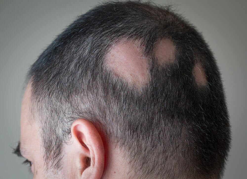 Persona con alopecia